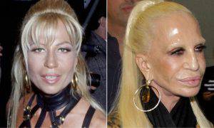 Donatella Versace prima dopo chirurgia