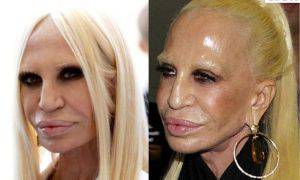 Donatella Versace prima dopo chirurgia