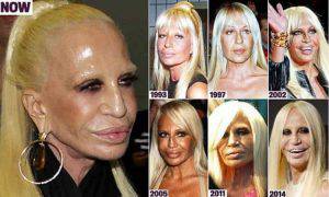 Donatella Versace prima dopo chirurgia