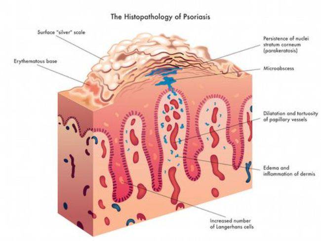 Psoriasi: c'è una dieta per gestire meglio i sintomi?