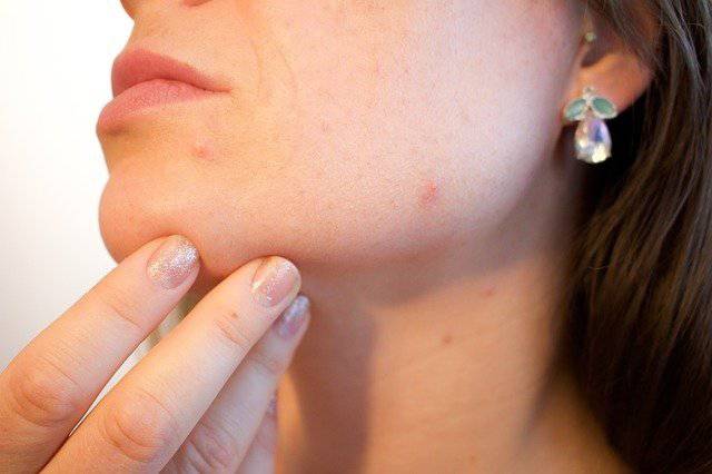 Acne: come prevenirlo