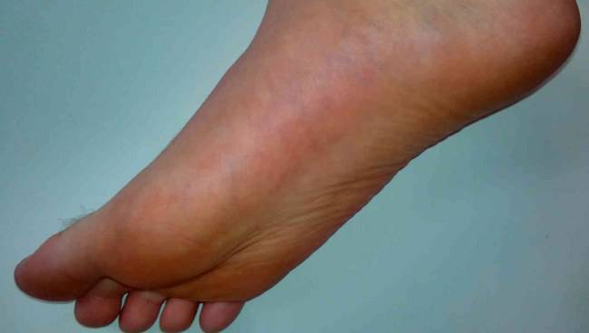 Piedi: hai questi segni? Potresti avere il colesterolo alto