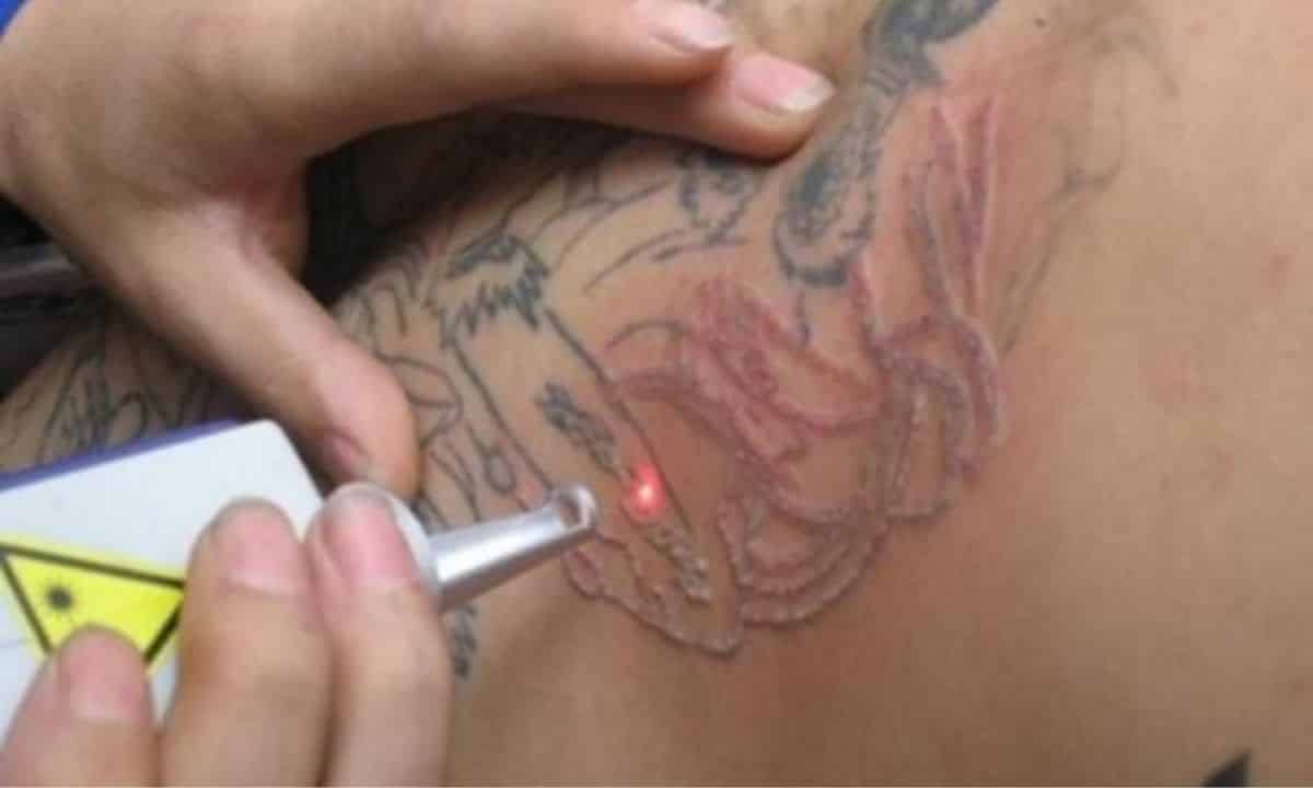 rimuovere tatuaggi prezzo