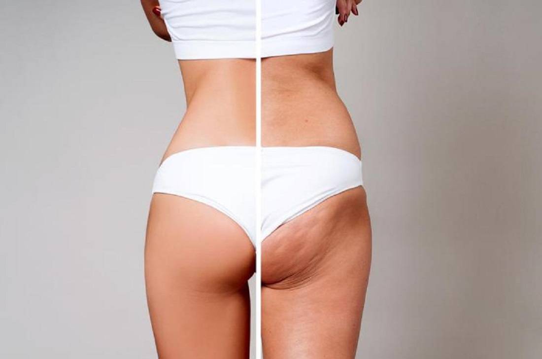 Cellulite: come fare per eliminarla?