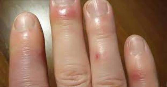 Gonfiori o rossori alle mani? Ecco cosa potrebbe essere
