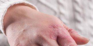 Gonfiori o rossori alle mani? Ecco cosa potrebbe essere