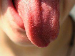 Lingua: se è di questo colore non sottovalutare il problema