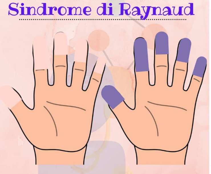 Sindrome di Raynaud