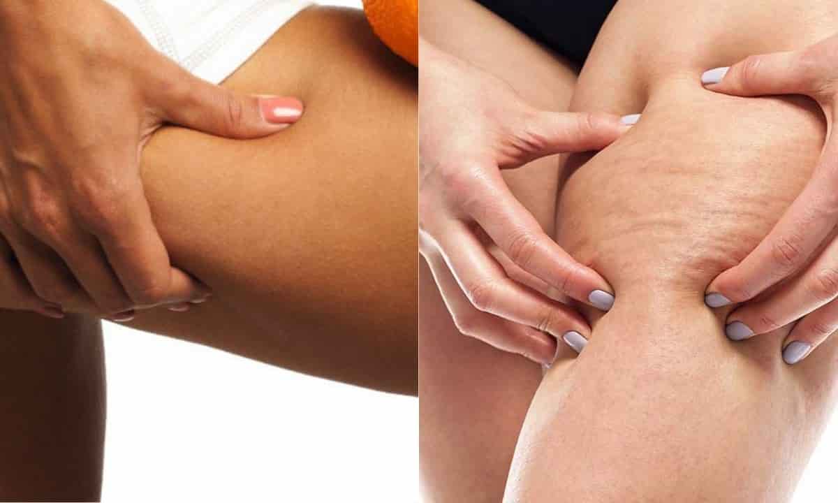 alcol erbe cellulite