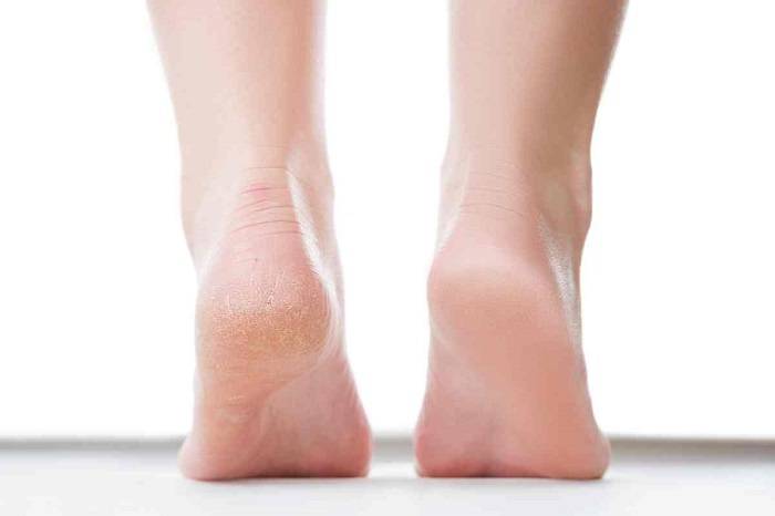 Talloni screpolati: come averli a prova di sandali in casa