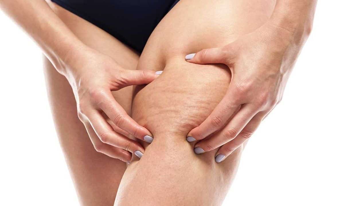 cellulite eliminala così