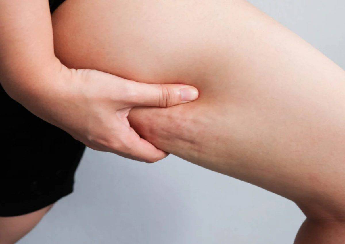 Cellulite: il rimedio per combatterla costa 1 euro