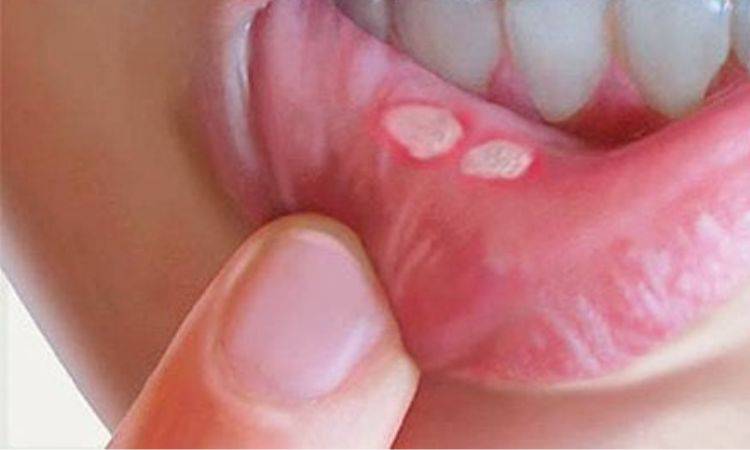 canker sores remedies