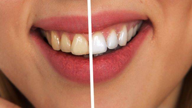 denti bianchi crema
