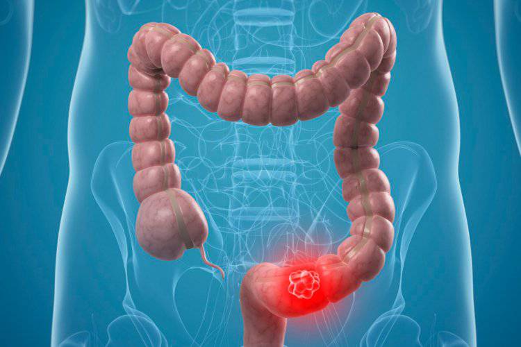 Cancro al colon, 5 sintomi della patologia (Libero Quotidiano)
