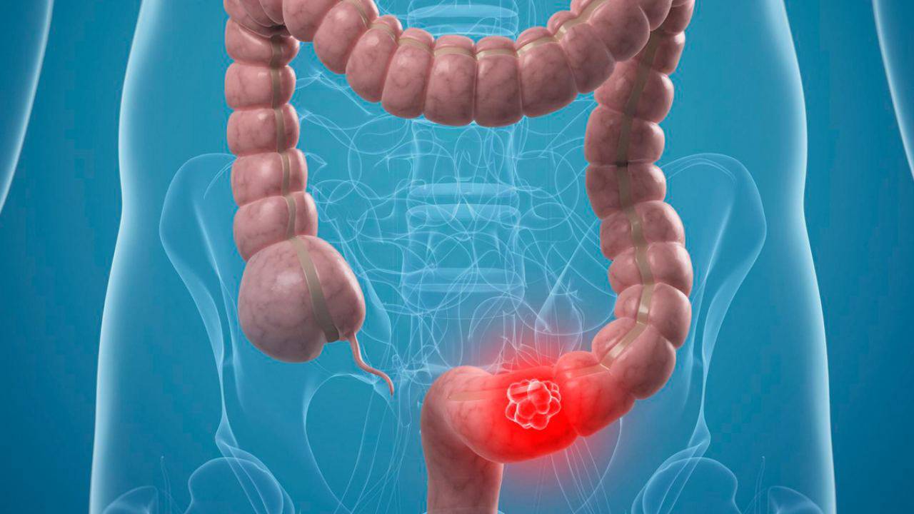 Cancro al colon, 5 sintomi della patologia (Libero Quotidiano)