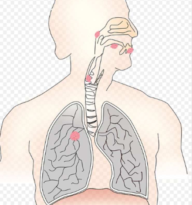 Cancro ai polmoni_ Arriva il sintomi dalle mani che ti stupirà