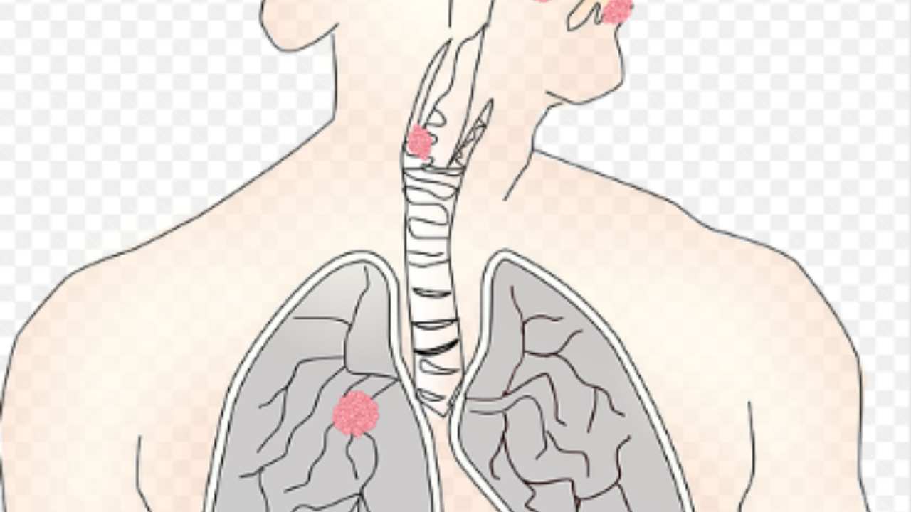 Cancro ai polmoni_ Arriva il sintomi dalle mani che ti stupirà