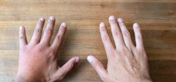 punte delle dita potrebbero diventare più grandi e gonfiarsi